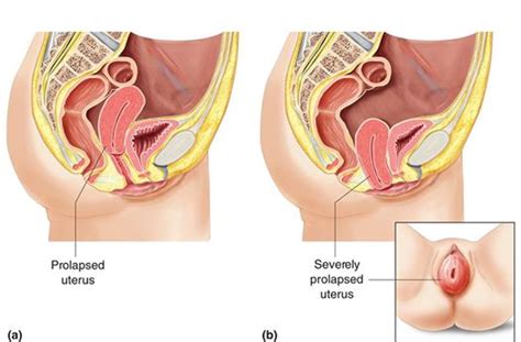 Womb, uterus, uterine, swallowed, rahim jatuh, female womb, maksud womb. Peranakan Jatuh/ Tombong Akibat Tak Menjaga Pantang Dengan ...