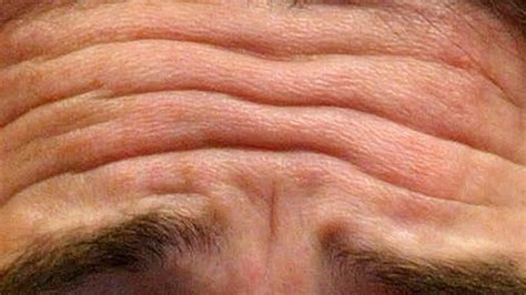 A full review of natural & medical solutions to look younger. Deep forehead wrinkles link to cardiovascular disease | BT