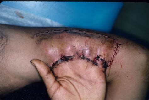 Trauma: Multiple finger degloving treated with medial cross arm flap ...