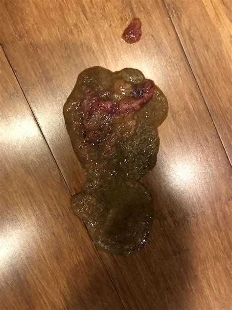 Taking pepto bismol for diarrhea. Bloody Vomit And Stool - Stools Item