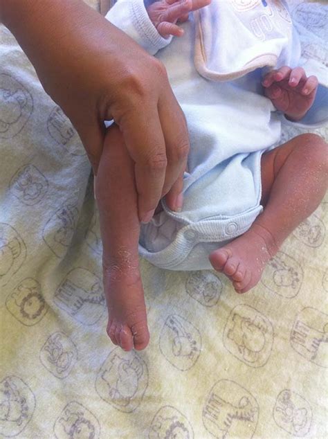 There is currently no known. Baby Clubfoot Journey | Southern California Foot & Ankle ...