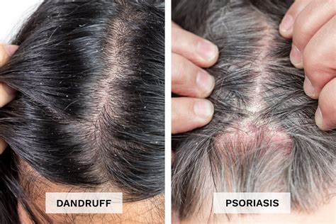 Scalp Psoriasis vs. Dandruff: What's Causing Your Flakes? | The Healthy