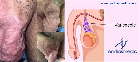 A lump in one of your testicles, swelling, visibly enlarged. Varicocele agrandamiento de las venas en los testículos ...