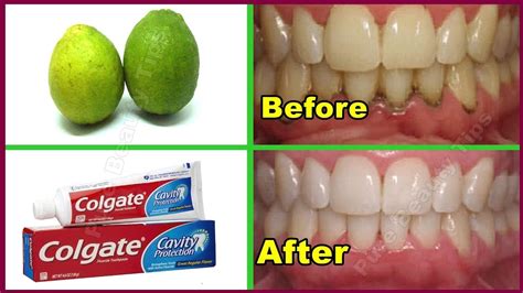 It is very important to process the right steps to get clean and white teeth with braces on correctly. Teeth Whitening Remedy ! Get whiten Teeth at home in 2 ...