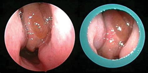 Use a head lamp with a nasal speculum to gently open up the nose. Paired images through an endoscope and a nasal speculum ...