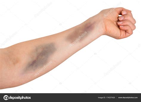 Het kan gebeuren dat u last krijgt van kleine bloedingen (blauwe plekken of kortdurende neusbloedingen). Gran hematoma en el brazo humano — Foto de stock ...