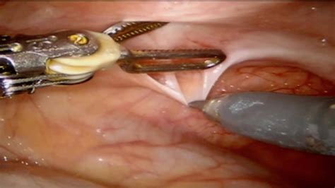 The lining builds up, then breaks down followed by bleeding. Robotic Management of Endometriosis - BroadcastMed