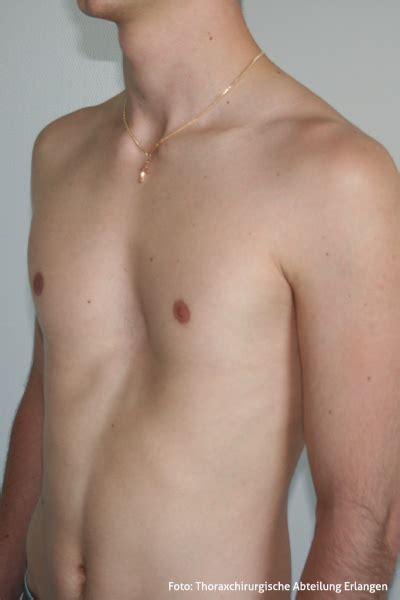 Baden und duschen nach der brust op. Thoraxchirurgie