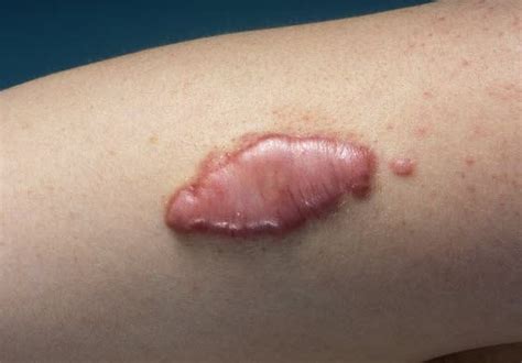 Read on to know more about how to treat wound scars permanently. How to Get Rid of Keloid Scars - How to remove that