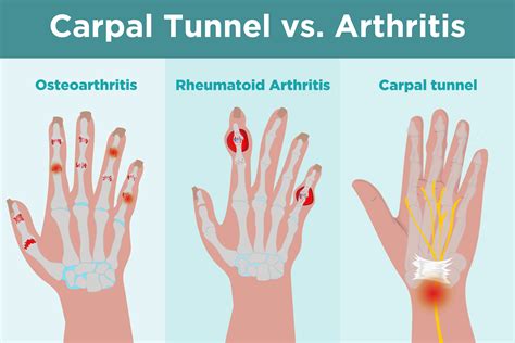 Great savings & free delivery / collection on many items. signs of carpal tunnel - signs of carpal tunnelsigns of ...