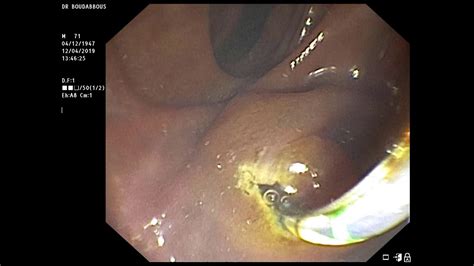 Pancreatic cancer can be hard to spot in the early stages. ERCP with SEMS for advanced pancreatic cancer, Dr Sami ...