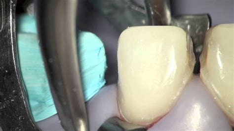 Follow these steps to ensure proper cementation of firstfit veneers. Porcelain Veneer Cementation - YouTube