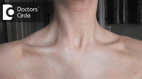 Waist = the bottom of your chest, where your body is narrower. What causes a sudden red rash around the neck in women ...