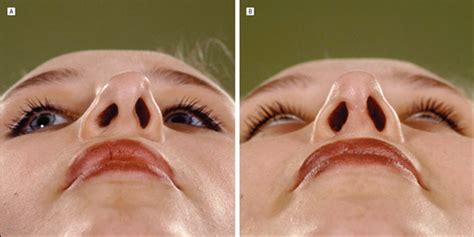 Small infections are common within the nasal vestibule that are usually caused by bacteria called staphylococcus. Postoperative Management of Nasal Vestibular Stenosis: The ...