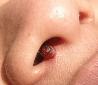 Plucking nose hair can lead to a bacterial infection. Pimple inside Nose, Bump, Zit, Ingrown, Cyst, Hurts, Sore ...