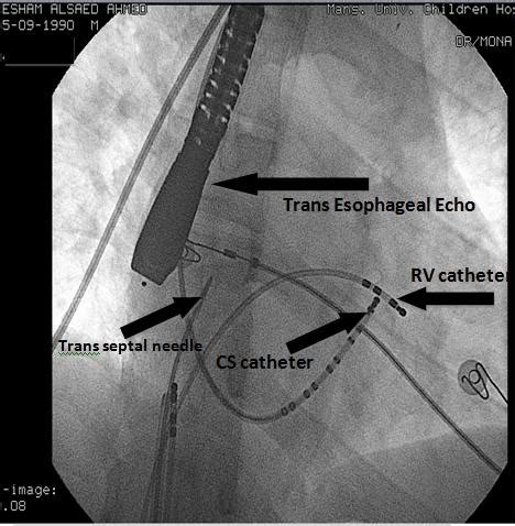 The coronary sinus receives drainage from most epicardial ventricular veins, including the oblique vein of the left atrium (and other left and right atrial. Fluoroscopic image in (RAO 30° view) showing trans-septal ...