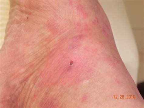 Me Verse Lupus: Ugly rashes