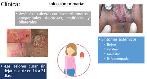 El virus del herpes simplex (vhs), es la causa de que aparezca el herpes genital, este virus a su vez se divide en dos tipos: Herpes genital