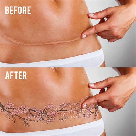 They're permanent body markings of a certain time and place in y. tummy tuck scar cover tattoo - Google Search | Tatoo ...