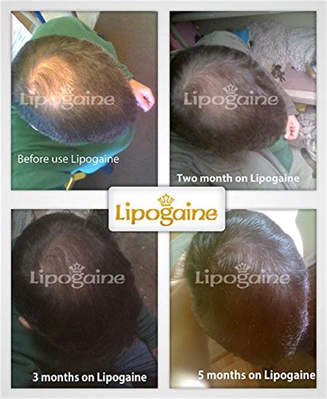 Alopecia is the general medical term for hair loss. Lipogaine for Men, Premium Minoxidil Hair Loss/ Hair ...