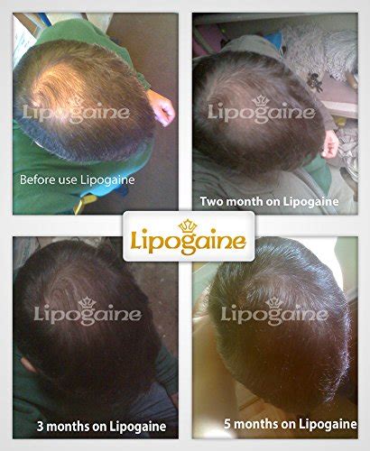 But hair loss after the age of six months or a significant loss during the first six months could be an indicator of a dilemma. Lipogaine for Men, Premium Minoxidil Hair Loss/ Hair ...