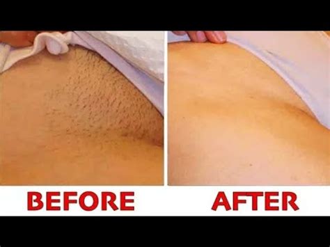 Ah, the pube and balls shave. STOP SHAVING!!! PROPER WAY TO REMOVE PUBIC HAIR WITHOUT SHAVING! NO INGROWN HAIR, NO BOILS - YouTube