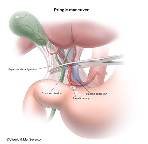 A) anterior abdominal wall b) diaphragm c) duodenum and stomach d) umbilicus e) posterior abdominal wall. The Pringle Manoeuvre