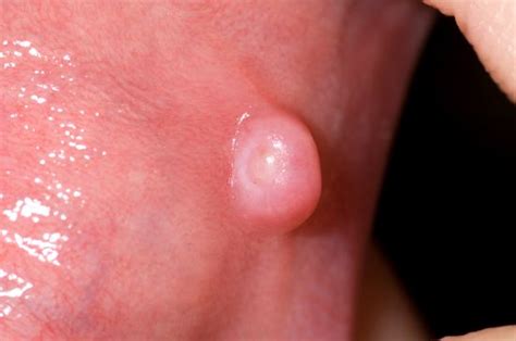 Many symptoms of throat cancer do not develop in the early stages of the disease. Wucherungen im Mund - Mund- und Zahnerkrankungen - MSD ...