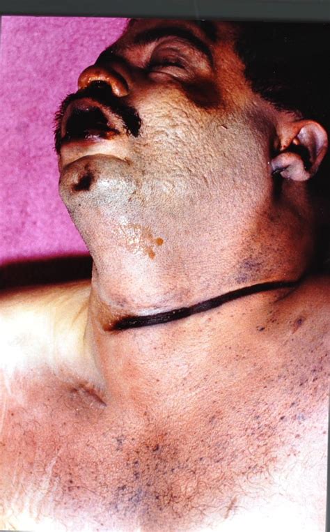 Defensive marks may also appear on the neck in the form of abrasions/fingernail scratches. Strangulation,ligature mark | Koronfel's Forensic Medcine