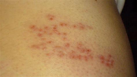 Herpes zoster, also called shingles, is an infection caused by the varicella virus. Si kurohet herpes? | GAZETA SHËNDETI