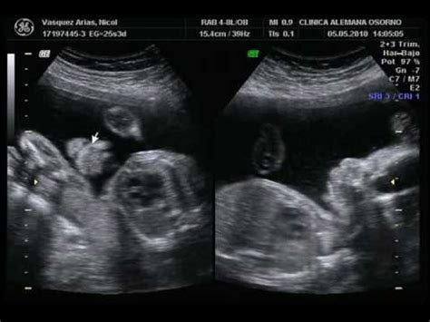 Durante los meses de elaboración, se producen cambios linear unit el alkalinity. ecografia de 26 semanas de gestacion. de maximiliano del ...