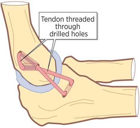 Tommy john surgery, more formally known as ulnar collateral ligament (ucl) reconstruction, is used to repair a torn ulnar collateral ligament inside the elbow. Young baseball players opting for Tommy John surgery ...