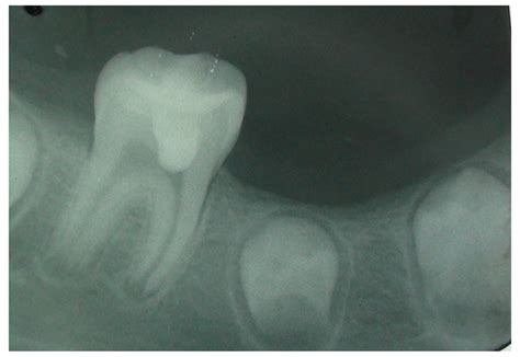 These dental procedures sound similar, but they are done for different reasons. Case Report: Immediate pain relief after partial ...