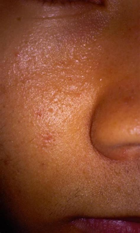 Rough Skin Texture - Scar treatments - Acne.org
