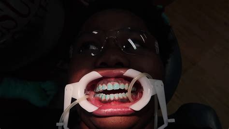 Some people have teeth that are too widely spaced apart. BRACES.....AGAIN!!! - YouTube