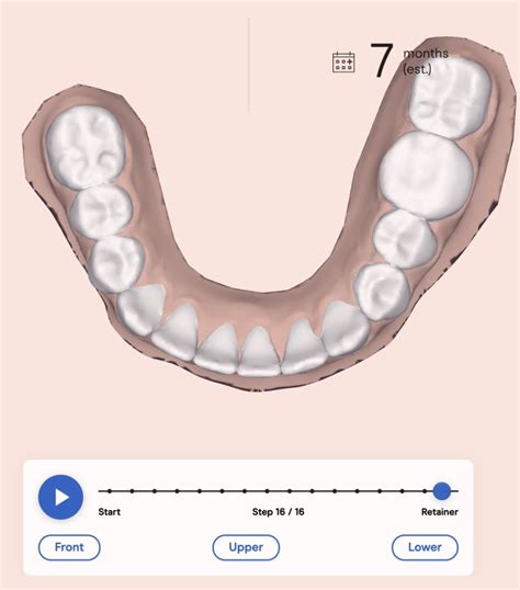 Check spelling or type a new query. Candid Clear Aligners Review - This WORKS! My Candid Smile ...