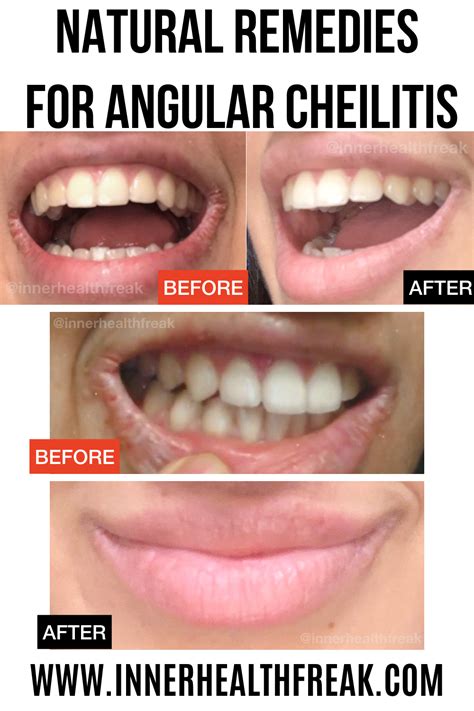 What cream is better for angular chilitis? ANGULAR CHEILITIS REMEDY NATURAL - Inner Health Freak