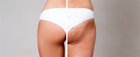 Cellulite is not specific to overweight people but excess weight may worsen the condition. Cellulite-Behandlung: Kosten, Methoden, Ärzte,