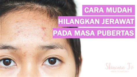 Tapi sebelum anda mengetahui cara menghilangkan jerawat secara alami dan cepat untuk pria dan wanita, anda perlu mengetahui apa itu jerawat dan penyebabnya. Cara Menghilangkan Jerawat Pada Masa Pubertas Yang Aman ...