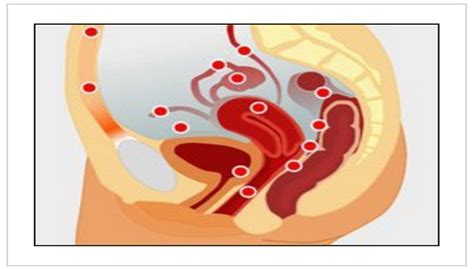 Si parla di endometriosi quando questo tessuto si sviluppa anche in sedi anomale, al di fuori della cavità l'endometrio presente in sedi anomale si comporta come quello che riveste la cavità uterina. La dieta giusta per l'endometriosi - CasaMedica