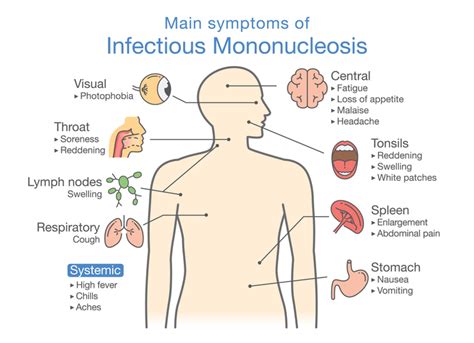 The virus spreads through saliva, which is why it's sometimes called kissing disease. ¿Qué es la mononucleosis? | ESMA Centre Mèdic