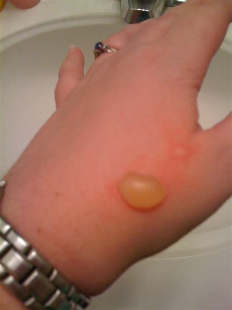Most bug bites and stings are usually just uncomfortable. Public Service Announcement: Never Sleep With a Laptop ...