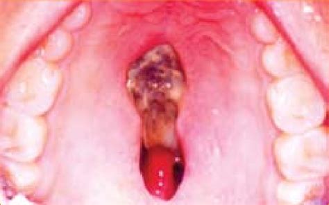 Oral syphilis signs and symptoms | syphilis stages, treatment and testing cost. Gummatous perforations of hard palate: note necrosis in ...