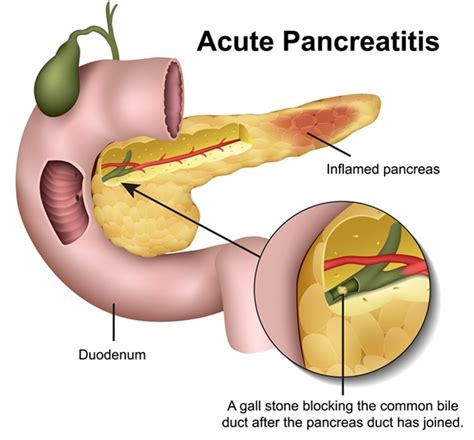 Pancreatitis in cats is divided into two pairs of categories: Dietary Guidelines for Pancreatitis