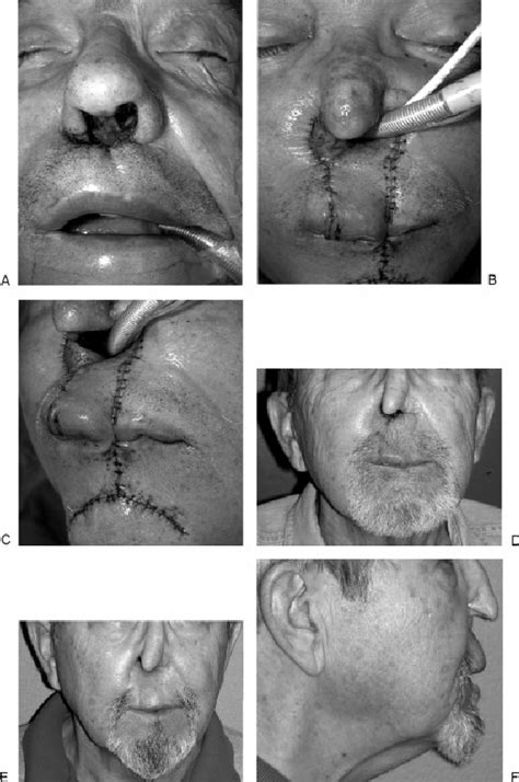 Small infections are common within the nasal vestibule that are usually caused by bacteria called staphylococcus. Recurrent squamous cell carcinoma of nasal vestibule and ...