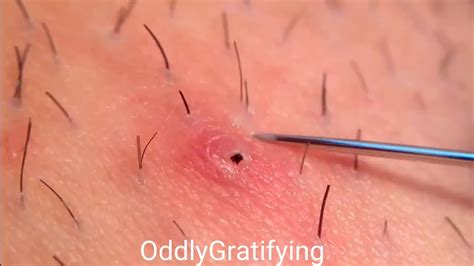 Just for your information, here is a picture of what these bumps look like in the armpit. Ingrown hairs and arm drainage 😱😱 - YouTube