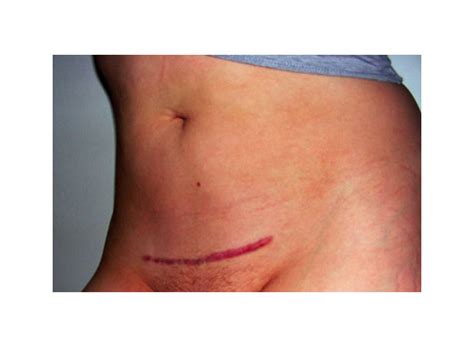 Check spelling or type a new query. C-Section Scar Pictures | Photo Gallery