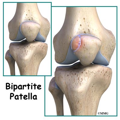 My right collar bone sticks out a bit. Bipartite Patella | eOrthopod.com