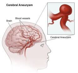Many have no symptoms and are not dangerous. Brain Aneurysms | Johns Hopkins Cerebrovascular Center