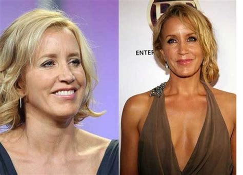 Felicity Huffman Plastic Surgery: Botox, Facelift Facial ...